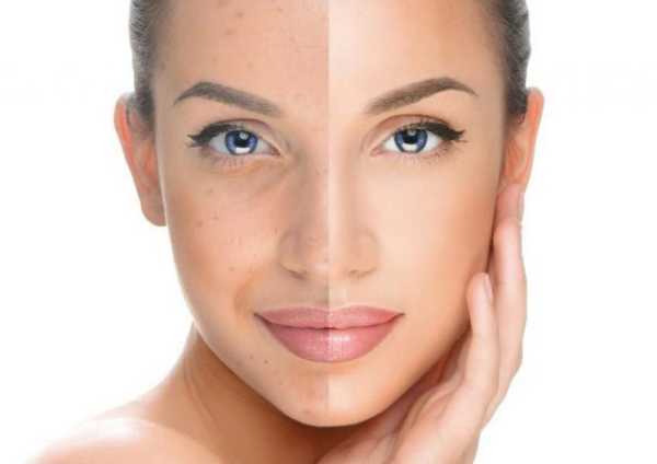 5 Effects of Retinoic Yellow Peeling