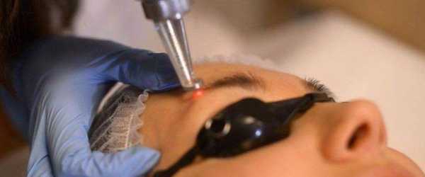 Laser removal of permanent makeup: effectiveness, contraindications and care